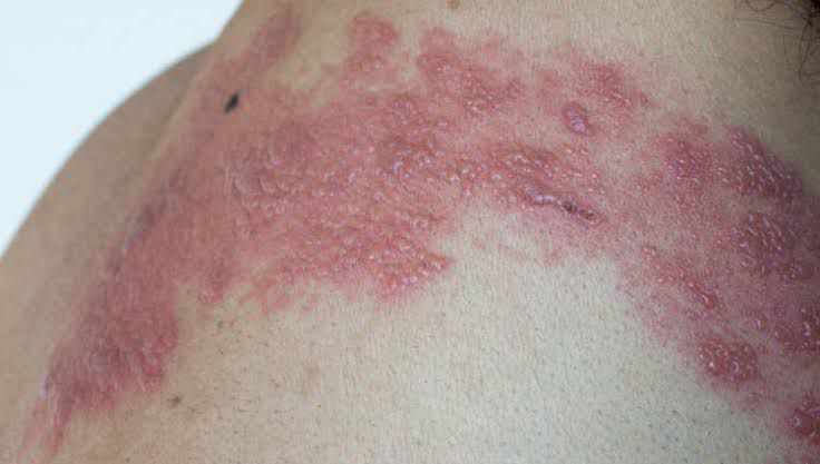 Herpes-Zóster