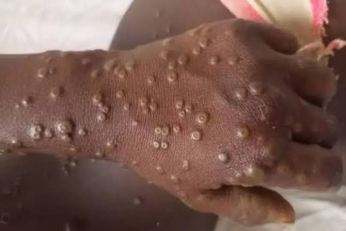 Mpox