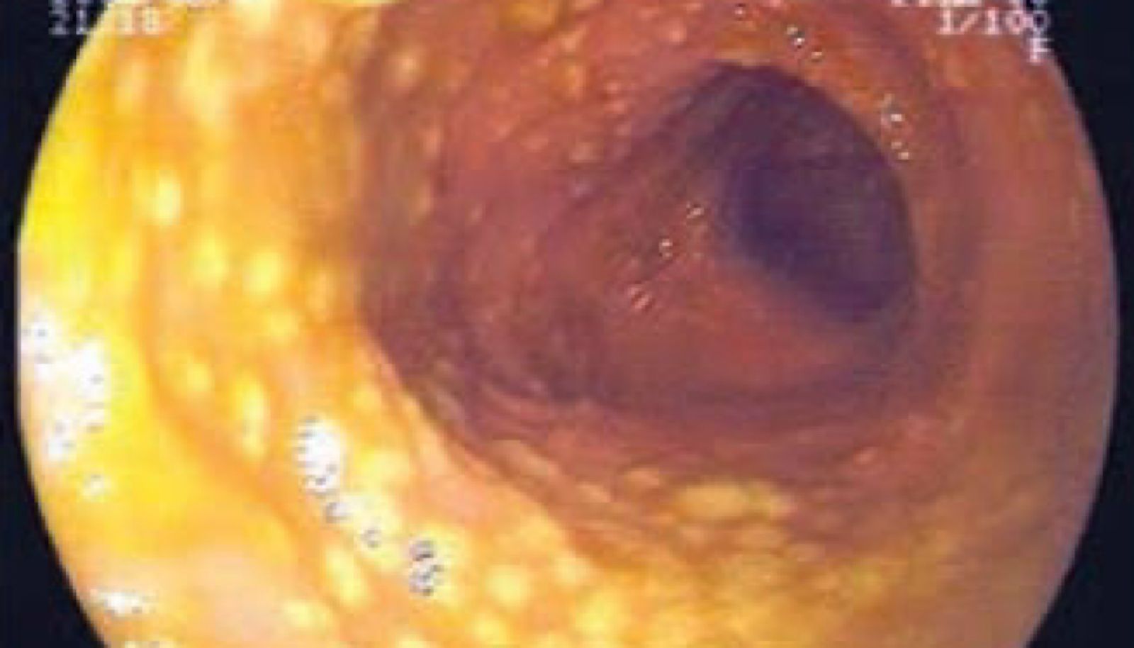 Diarreia por Clostridioides difficile